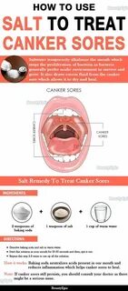 how to use salt to treat canker sores Causes Of Cellulite, Reduce Cellulite...