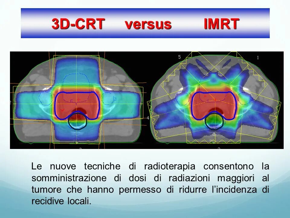 Трехмерная конформная лучевая терапия (3d-CRT). IMRT терапия. Лучевая терапия с модулированной интенсивностью (IMRT). IMRT IGRT лучевая.