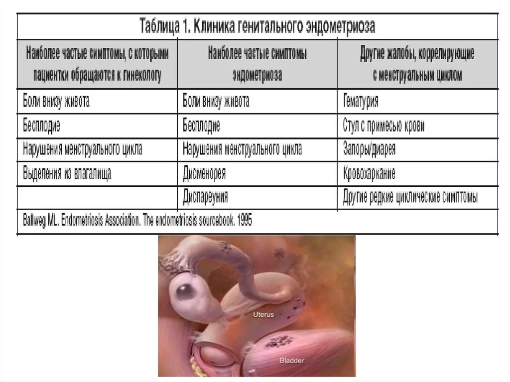 Клиника генитального эндометриоза. Эндометриоз таблица. Классификация наружного генитального эндометриоза. Эндометриоз классификация. Доброкачественные опухоли женских половых органов