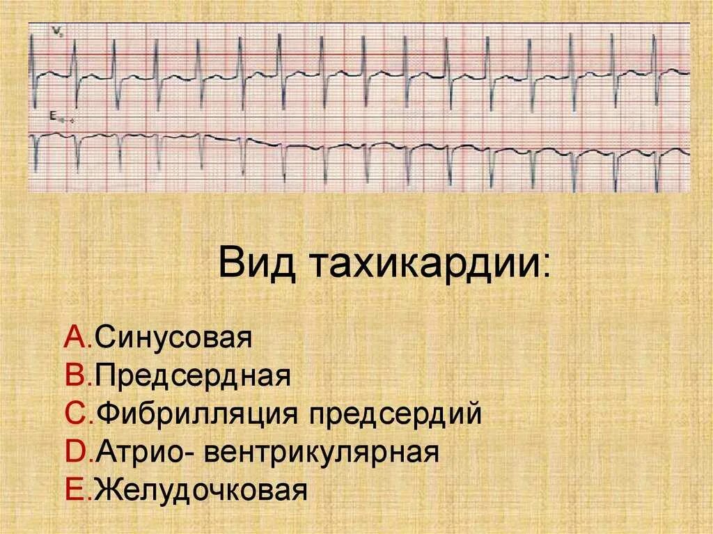 Синусовая тахикардия вертикальное. Мультифокальная предсердная тахикардия. Синусовая и предсердная тахикардия. Синусовая тахикардия препараты. Синусовая тахикардия симптомы.