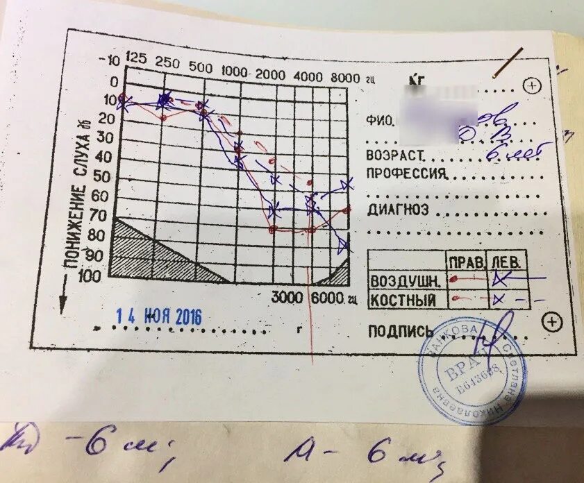 Кондуктивная тугоухость 2 степени аудиограмма. Кондуктивная тугоухость 1 степени аудиограмма. Тугоухость форум. Нейросенсорная тугоухость 2 степени аудиограмма. Могут ли в 12 недель поставить тугоухость.