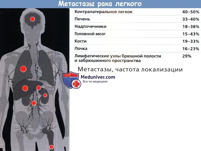 Отдаленные метастазы при раке. Метастазирующие опухоли.