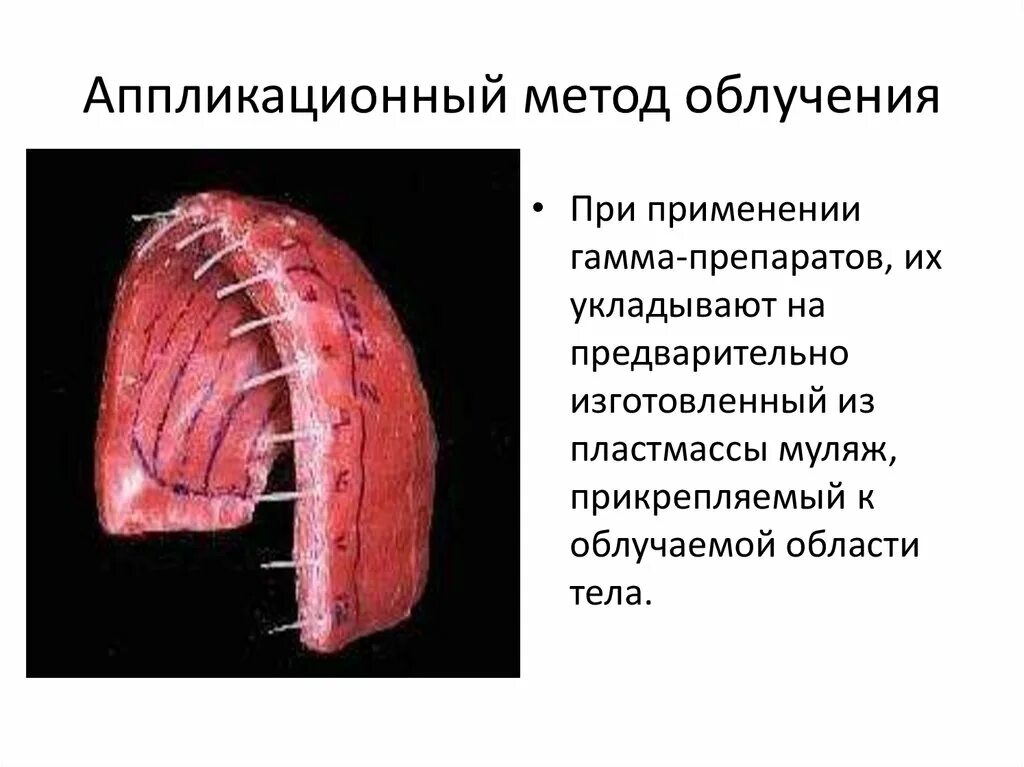 Метод радиальных. Аппликационная гамма-терапия. аппликационное облучение. аппликационная радиотерапия. аппликационный метод облучения.