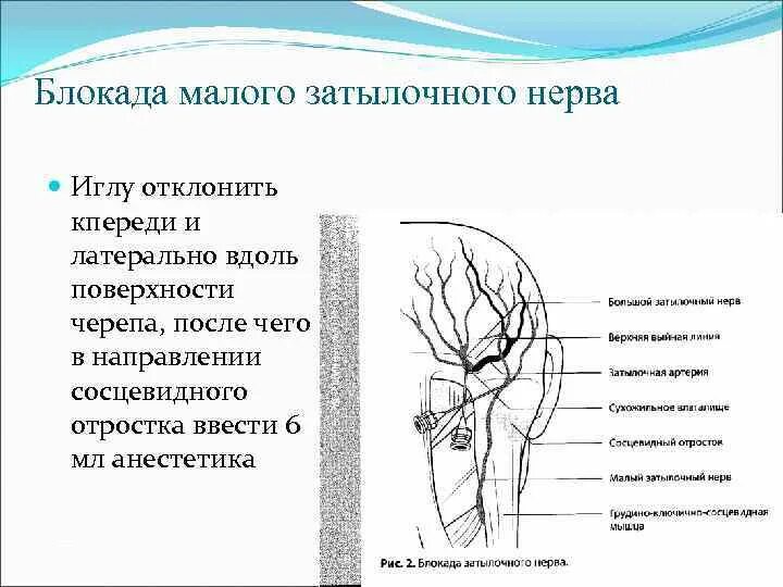 Нейропатия затылочного. Нейропатия затылочного нерва блокада. Блокада большого затылочного нерва техника. Затылочный нерв анатомия схема. Методика блокады большого затылочного нерва.