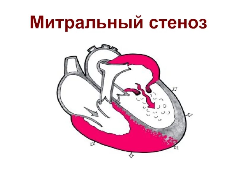 Сердечный стеноз. Митральные пороки сердца (стеноз, недостаточность. Приобретенные пороки сердца митральный стеноз. Стеноз митрального клапана гемодинамика схема. Пороки сердца митральный стеноз схема.