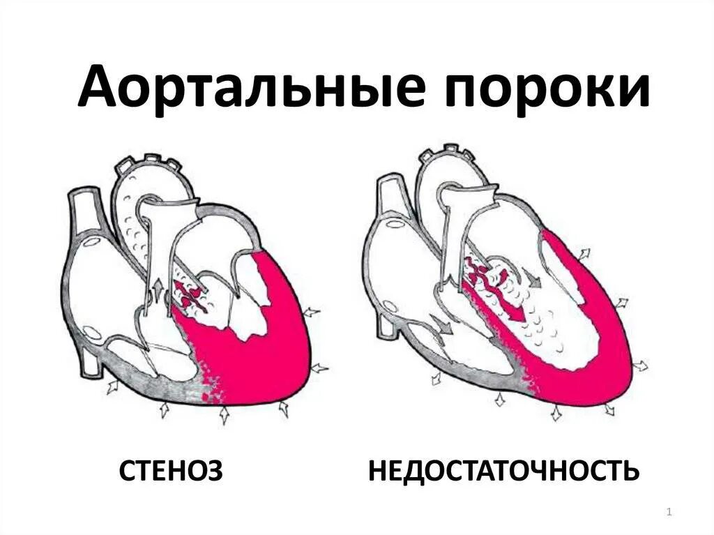 Сердечный стеноз. Стеноз аортального клапана схематично. Стеноз и недостаточность аортального клапана. Порок сердца стеноз аортального клапана. Стеноз аортального клапана рисунок.