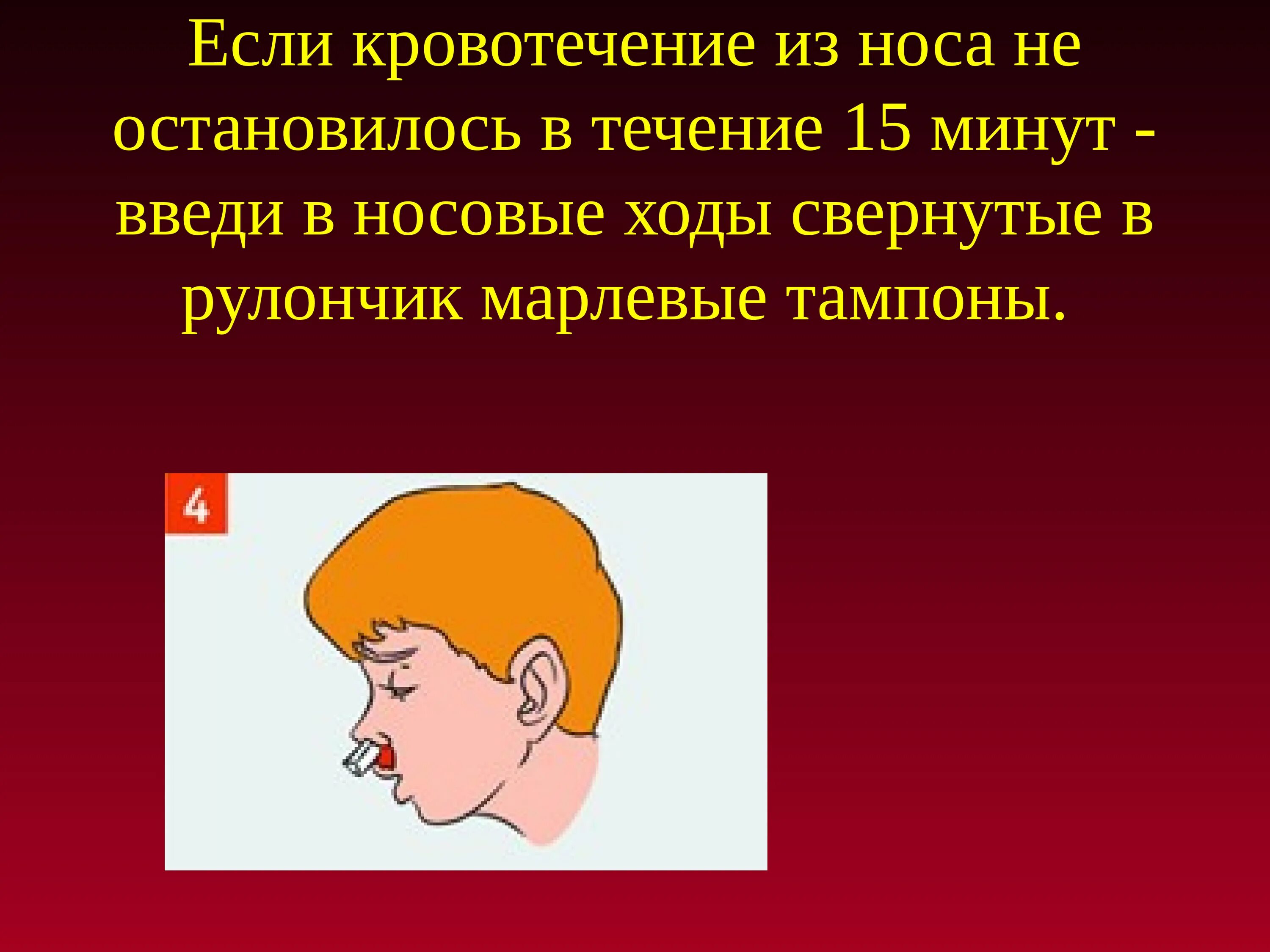 Кровь из носа просто так почему. Сильное кровотечение из носа. Остановить кровь из носа у взрослого. Кровотечение из носа для презентации.