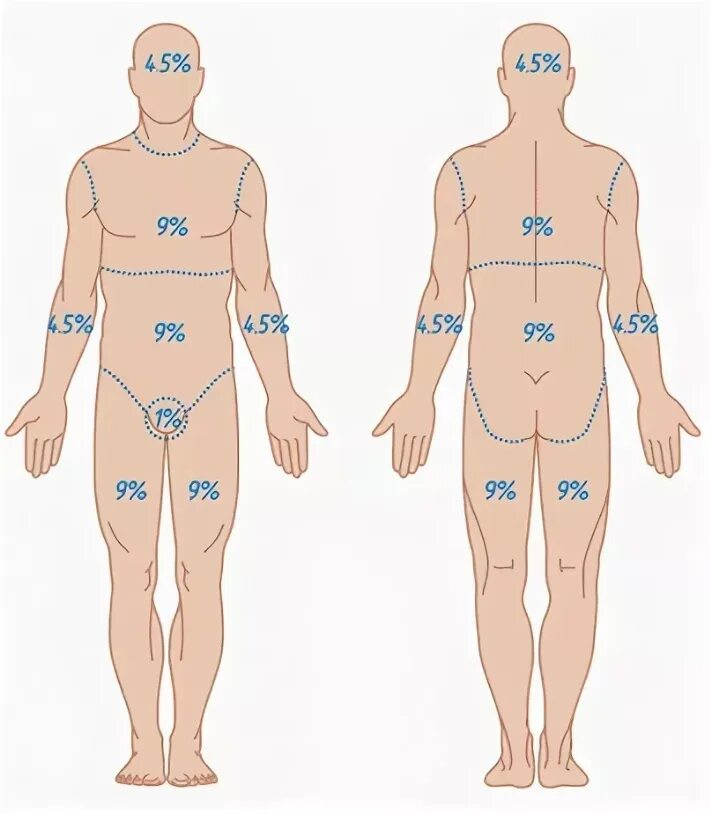 Площадь ожогов по правилу девяток. Площадь ожогов правило девяток. Площадь ожоговой поверхности правило девяток. Правило 9 процентов при ожогах. Пл тела