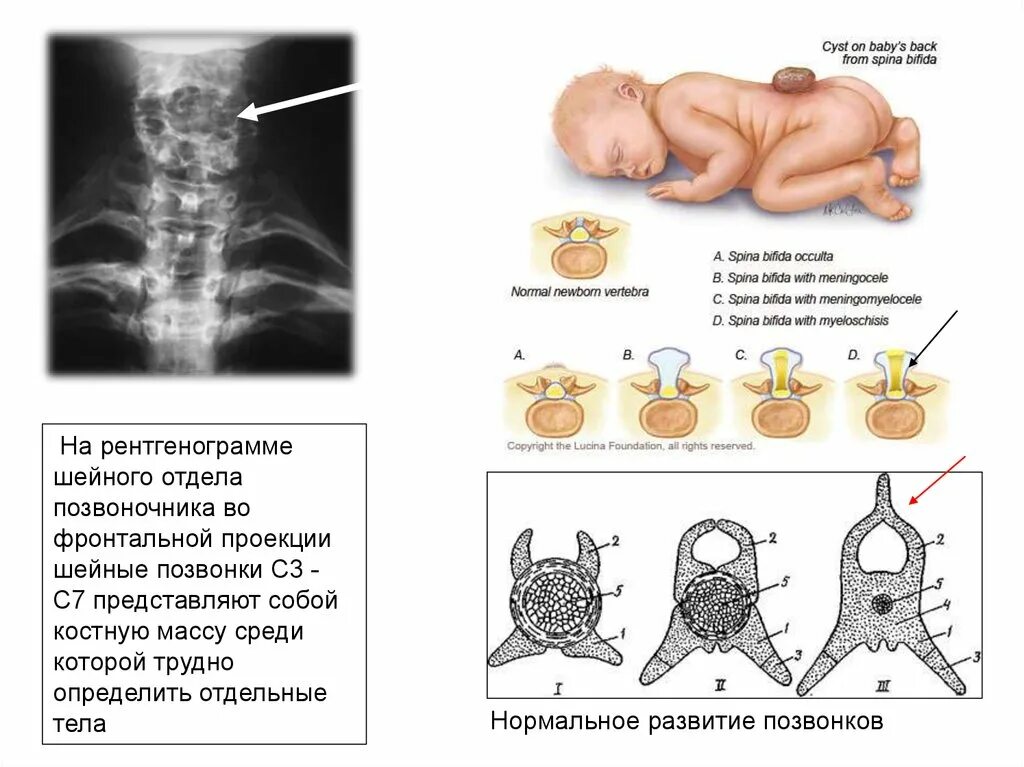 Расщелина позвоночника s1 позвонка. Аномалии развития поясничных позвонков. Порог развития позвоночника. Аномалии развития позвоночника у детей.