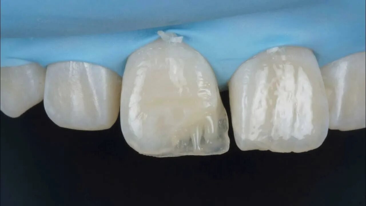 Восстановление передних зубов. Наращивание зубов композитными материалами. Реставрация фронтальных зубов. Реставрация переднего зуба.