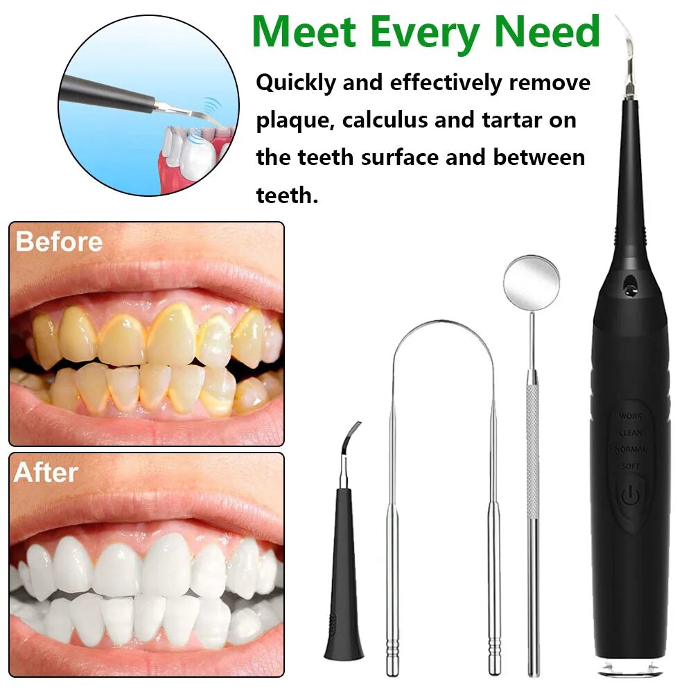 можно ли ирригатором убрать камень. можно ли ирригатором убрать камень. пародонтологическая щётка для ирригатора. ирригатор для зубов до и после. скалер стоматологический для снятия налета.