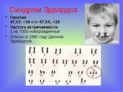 Кариотип больного с синдромом эдвардса