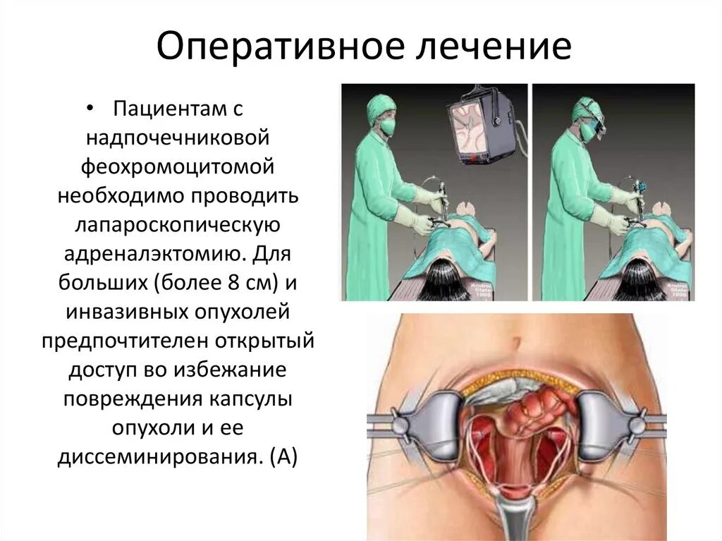 Что значит оперативное лечение. Феохромоцитома операция. Операция лапароскопическая адреналэктомия. Операция феохромоцитома хирургия.