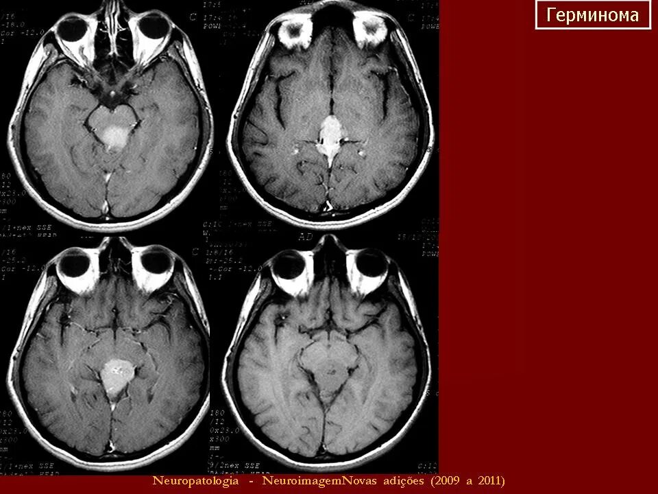 Герминома. Герминома пинеальной области. Герминома головного мозга.
