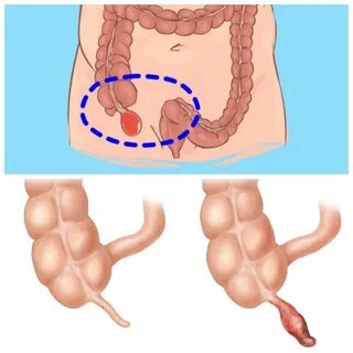 Аппендицит тыртық фотосуреті