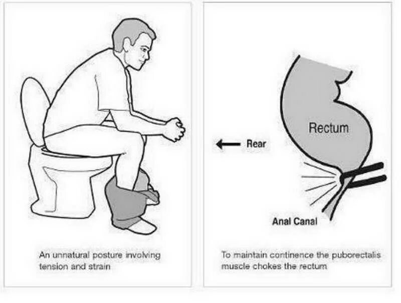 Почему гоняет в туалет. Правильная поза для дефекации. Поза для правильного хождения в туалет. Правильная поза для туалета. Правильная поза для туалета по большому.