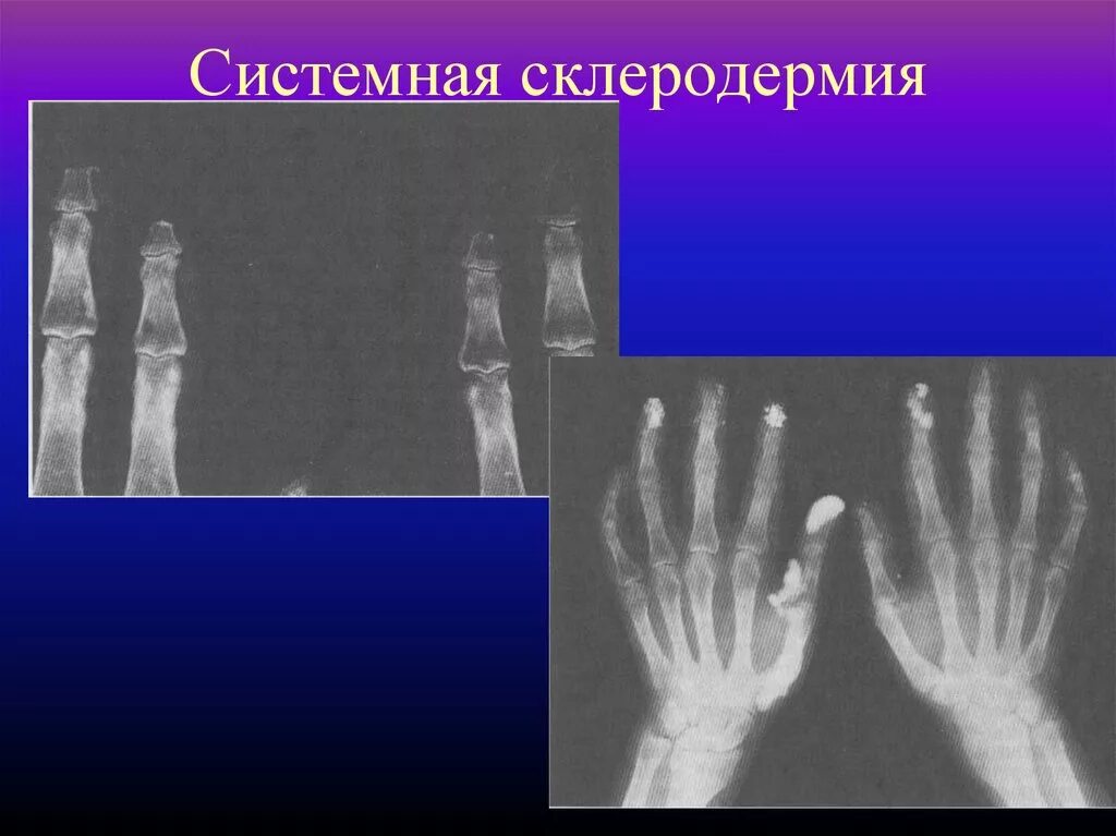 Диффузную системную склеродермию