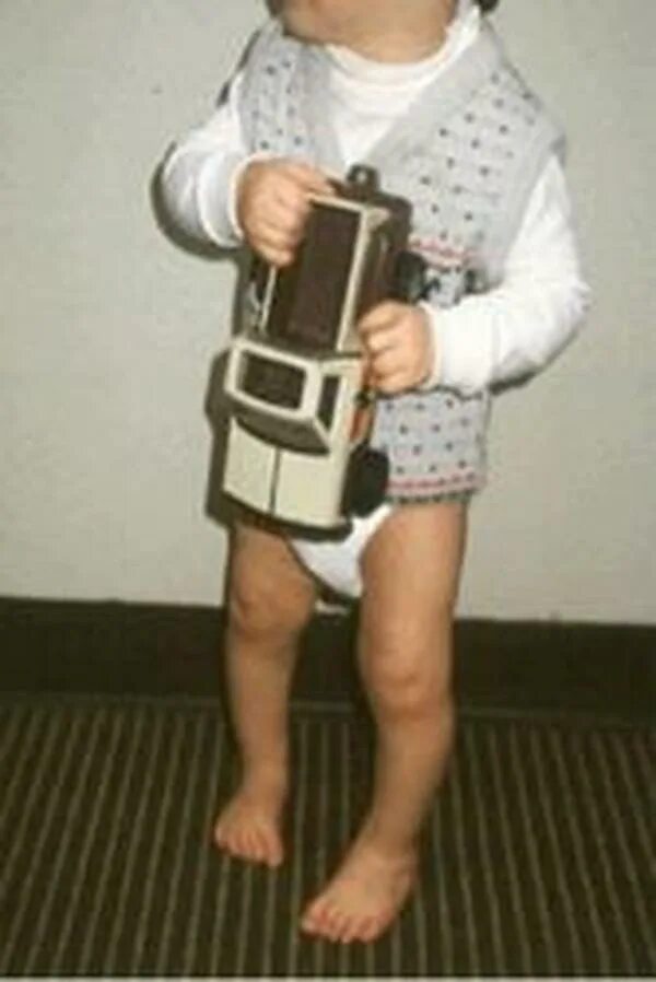 Ребенок косолапит в 2 года. Эквиноварусная косолапость. Ребенок косолапит при ходьбе. Вальгусная деформация косолапие. Ребенок косолапит при ходьбе.