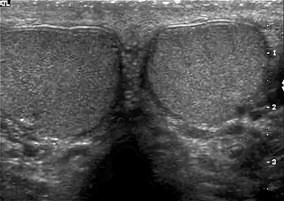 Расшифровка УЗИ мошонки. УЗИ мошонки и гениталии Разное. Яички в мошонке поперечный срез. Артерии яичка