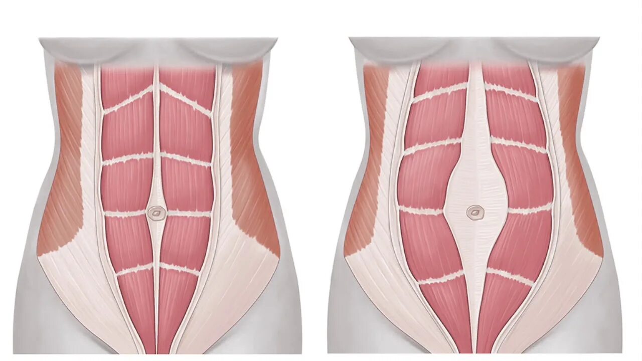 Диастаз мышц белой линии. Мышцы живота анатомия диастаз. Прямые мышцы живота диастаз. Растет живот после 30 у женщины