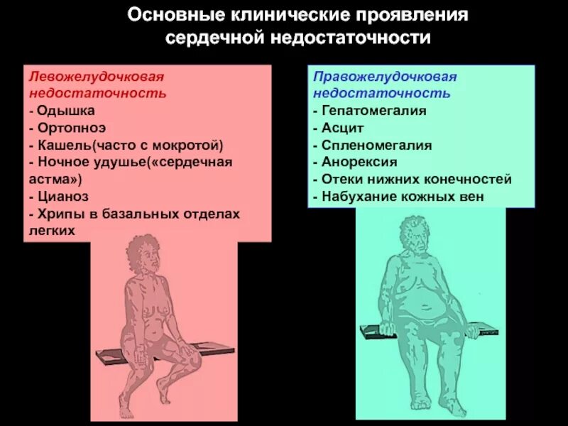 Симптомы острой левожелудочковой недостаточности сердца. Клинические проявления сердечной недостаточности. Клинические проявления правожелудочковой сердечной недостаточности. Клинические симптомы острой левожелудочковой недостаточности. Дыхание при сердечной недостаточности