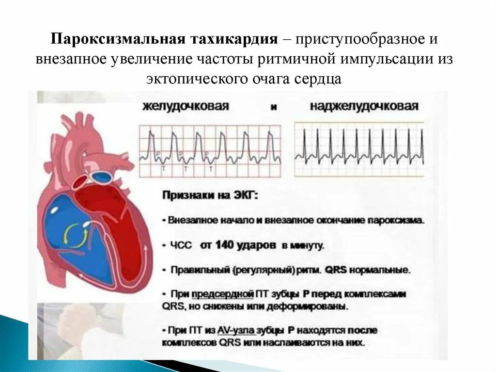 Пароксизм это простыми словами. Пароксизм желудочковой тахикардии ЭКГ. Пароксизмальная тахикардия ЭКГ диагностика. ЭКГ критерии пароксизмальной суправентрикулярной тахикардии. Пароксизмальная тахикардия у детей ЭКГ.