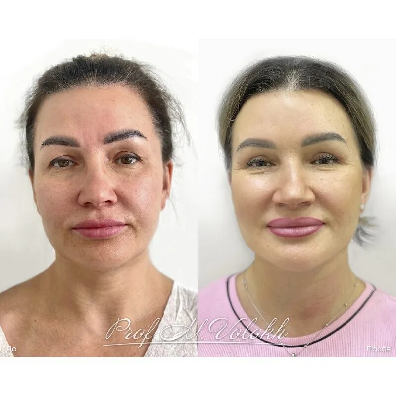 пациентка 46 лет. аугментационнач мама пластика. возрастное увеличение носа. малярпластика уменьшение скул казахстан. пациентка 46 лет.