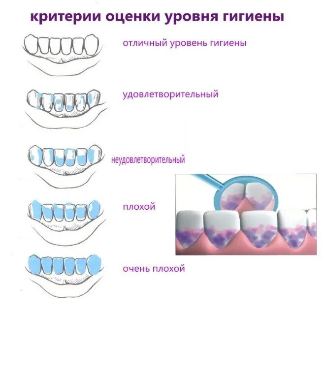 Уровень гигиены полости рта. Индикатор зубного налета. Индикатор для налета зубов. Средства для индикации зубного налета. Индикатор налета на зубах для детей.