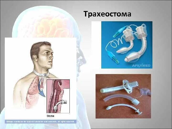 Трахеостома трубка ивл. Трахеостома слизь. Трахеостома слизь. Трахеостомическая трубка (вид 136500) 8 мл, 75 и 97 мл100/870/080. Памятка для пациента с трахеостомой.
