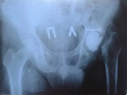 Тазобедренные травмы