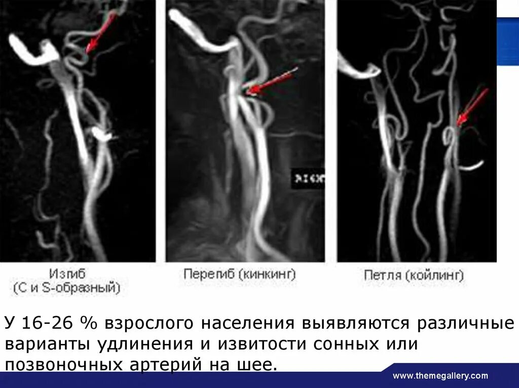 Изгиб вса. Койлинг позвоночной артерии. Кинкинг ВСА. S-образная извитость внутренней сонной артерии. Патологическая извитость сонных артерий койлинг.