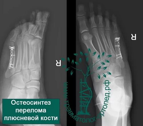 Остеосинтез 5 плюсневой кости стопы. Рентген перелома 5 плюсневой кости. Перелом 5 плюсневой кости остеосинтез. Рентген после перелома плюсневой кости 5. Остеотомия 1 плюсневой кости.
