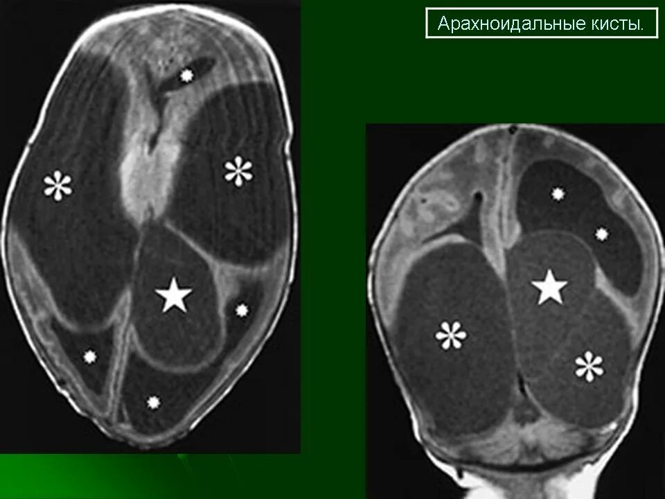 Арахноидальная киста медунивер. Арахноидальная киста срединной щели. Арахноидальная киста левого мостомозжечкового угла. Ретроцеребеллярная арахноидальная киста кт. Киста головного мозга армия