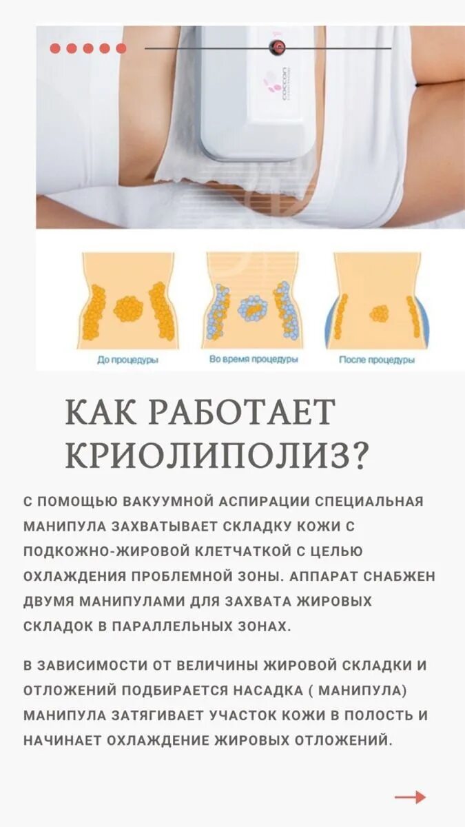 Криолиполиз как работает. Процедура криолиполиза. зоны для криолиполиза. криолиполиз протокол процедуры.
