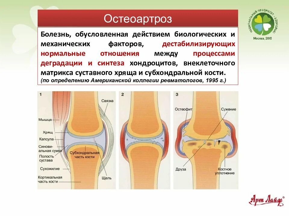 Явления остеоартроза