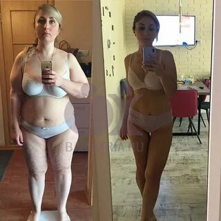 Бариатрическая хирургия 