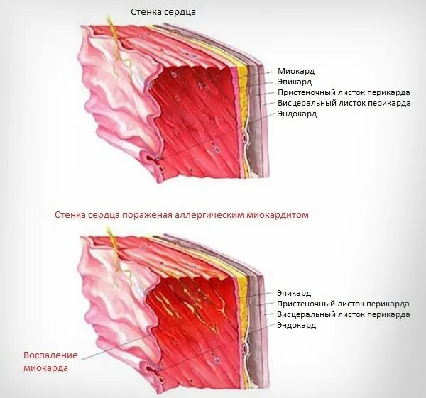 Миокард латынь. Воспаление миокарда миокардит. Инфекционно-аллергический миокардит. Аллергический миокардит. Воспаление эндокарда и миокарда.