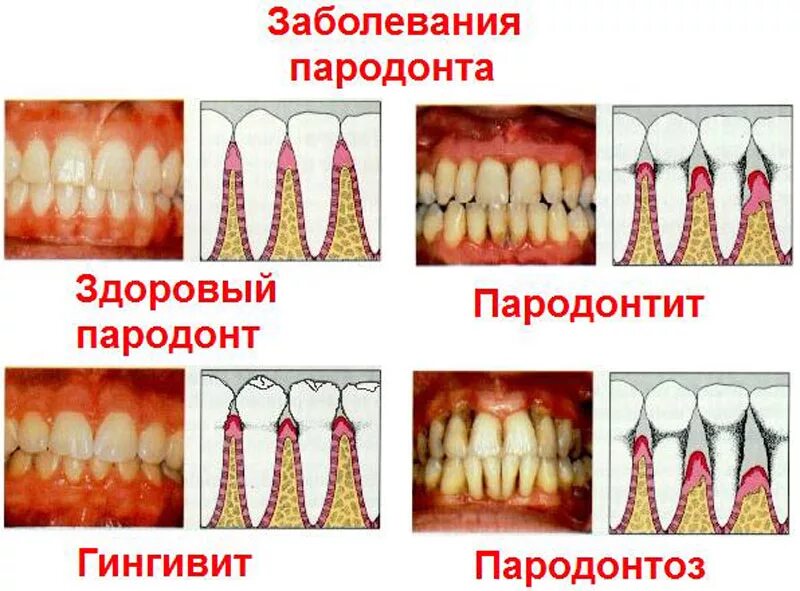 Заболевания пародонта виды