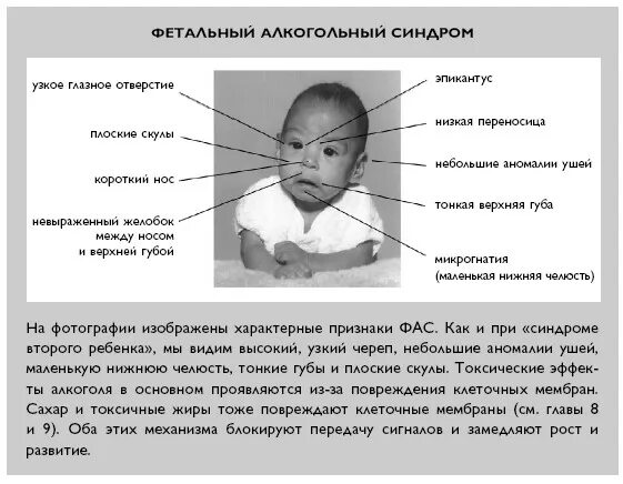 Фетально алкогольный синдром