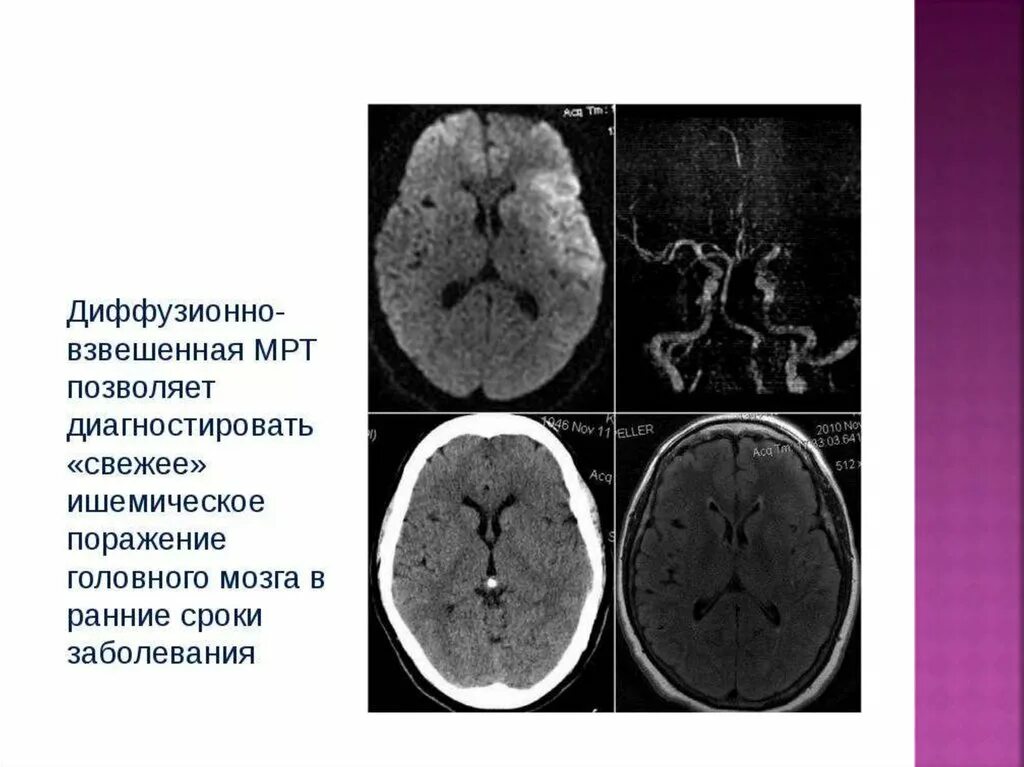 Диффузные изменения головного мозга. Ишемический онмк мрт. кт головного мозга онмк. ишемический онмк на кт. мультифокальный онмк по ишемическому типу.