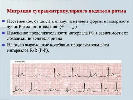 Экг миграция водителя ритма что это значит