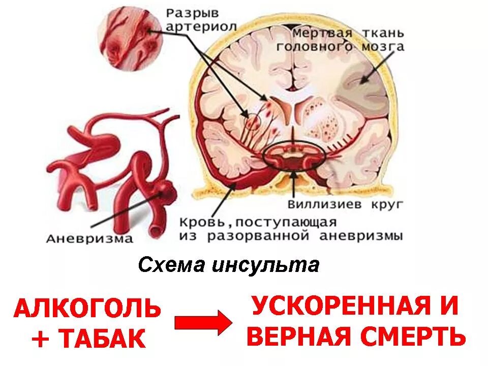 Зона инсульта. Инсульт схема.