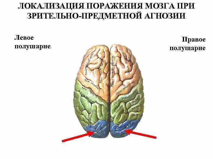 Тактильная агнозия локализация поражения. Локализация поражения при зрительной агнозии это. Поражение левого полушария. Зрительные агнозии на мозге.