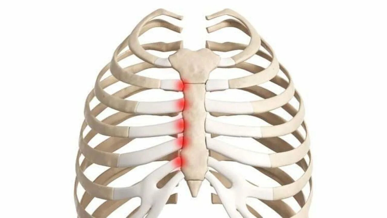 Боли в ребрах легкие. Синдром Титце хондрит реберный. Синдром Титце грудная клетка.