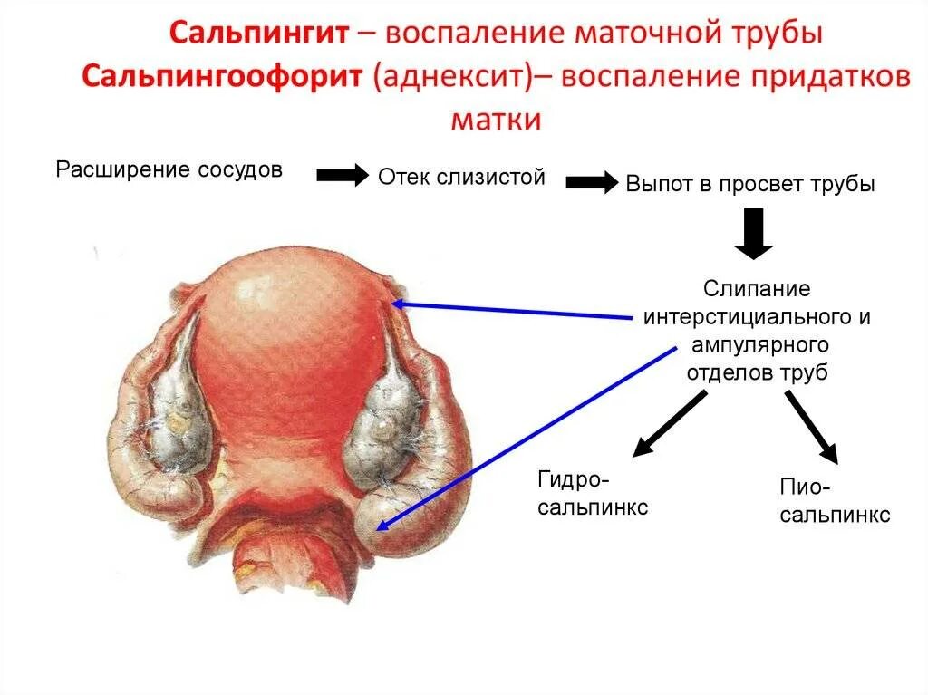 Болят ли придатки. Острый сальпингит клиника. Воспаление матки, трубы и яичников. Клиника воспаления маточных труб. Острый Гнойный сальпингоофорит.