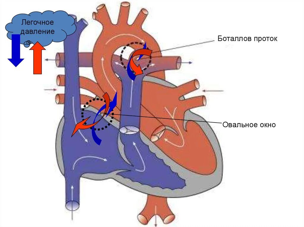 1 3 окно в сердце. Открытый артериальный проток Баталов. Открытый артериальный (боталлов) проток (ОАП). Открытый (персистирующий) артериальный проток. Открытый артериальный проток и овальное окно.