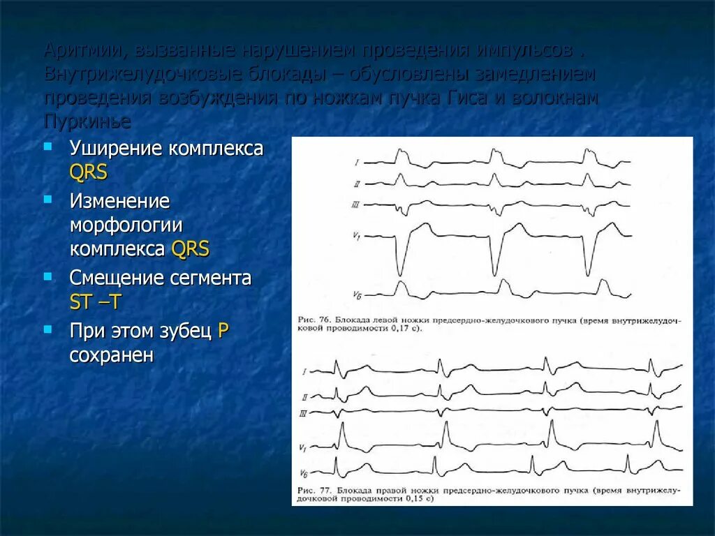 Блокада qrs. Блокада волокон Пуркинье на ЭКГ. Внутрижелудочковая блокада QRS. Уширение комплекса QRS. Изменение комплекса QRS.