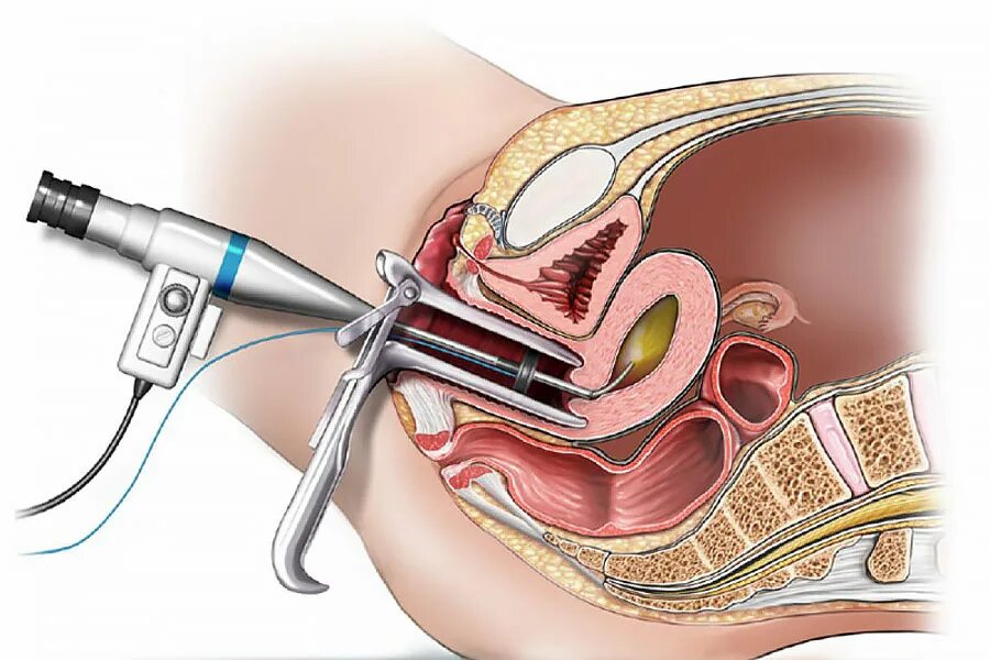 Гистерорезектоскопия миомы. Гистерорезектоскопия полипа. Миома матки гистероскопия. Гистерорезектоскопия полипэктомия. Гистерорезектоскопия полипа эндометрия.
