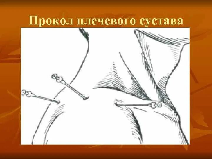 Пункция сустава техника выполнения. Пункция плечевого сустава топографическая анатомия. Точки пункции плечевого сустава топографическая анатомия. Пункции суставов топографическая анатомия. Пункция плечевого сустава точки пункции.
