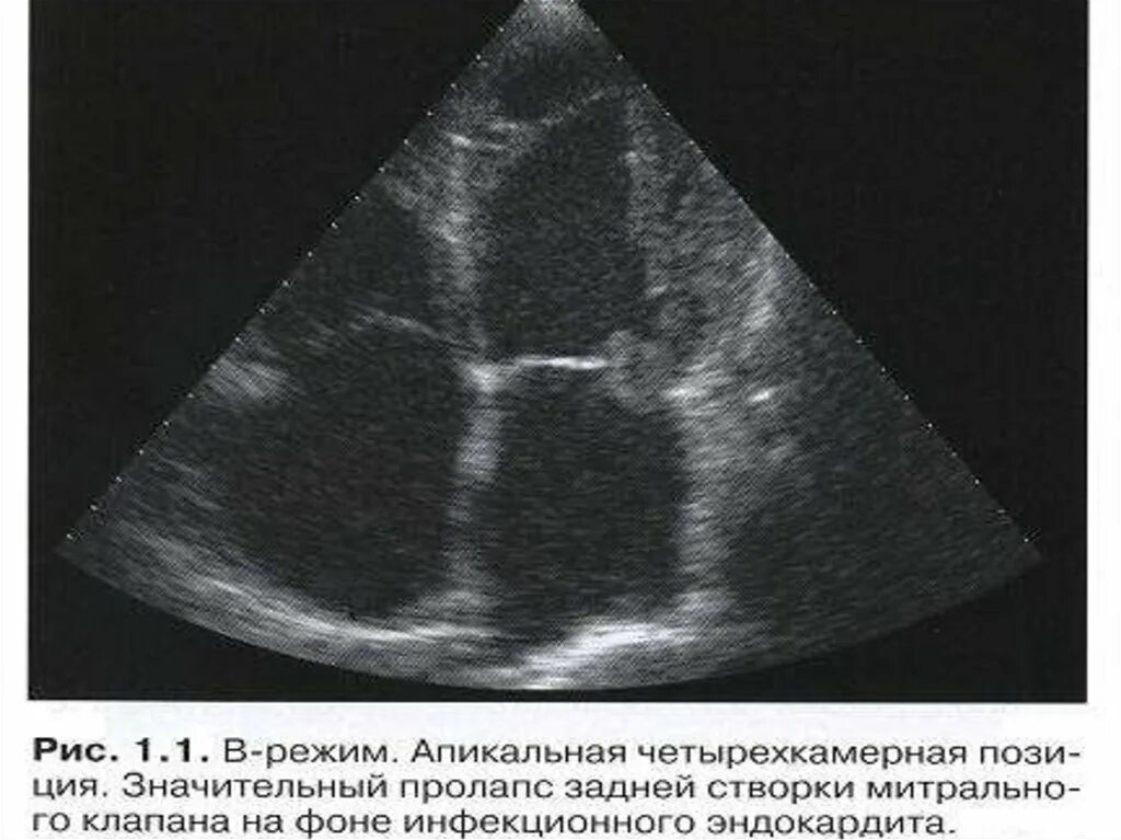 Дегенерация митрального клапана. Эндокардит митрального клапана УЗИ. Инфекционный эндокардит трикуспидального клапана ЭХОКГ. Пролапс митрального клапана на УЗИ сердца. Бактериальный эндокардит ЭХОКГ.